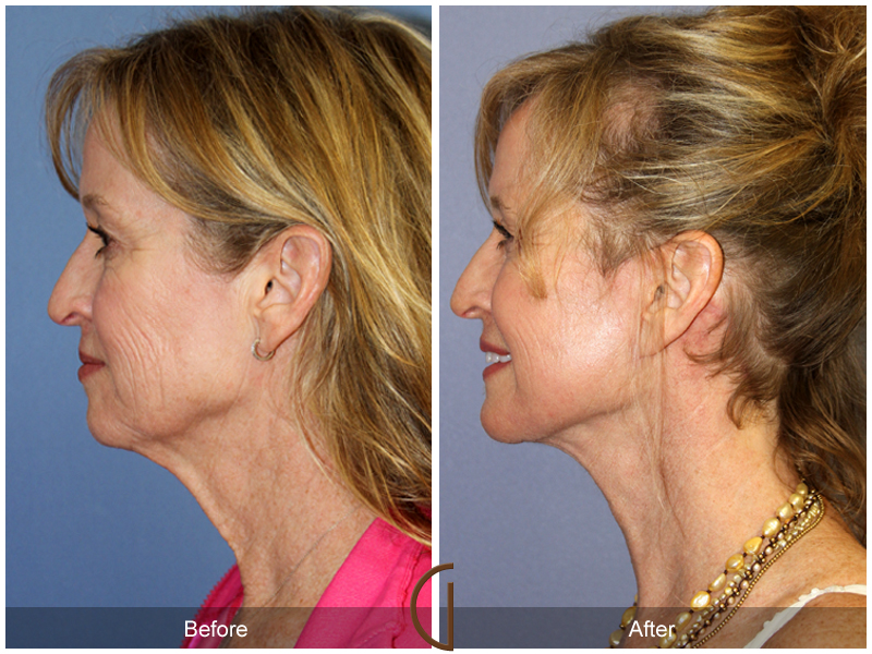 Female Facelift  Before & After Image