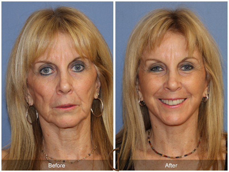 Female Facelift  Before & After Image