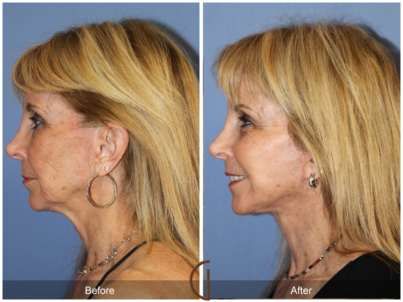 Female Facelift  Before & After Image