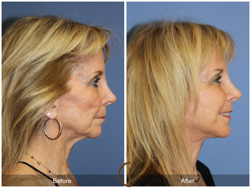 Female Facelift  Before & After Image