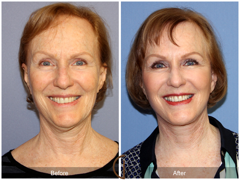 Female Facelift  Before & After Image