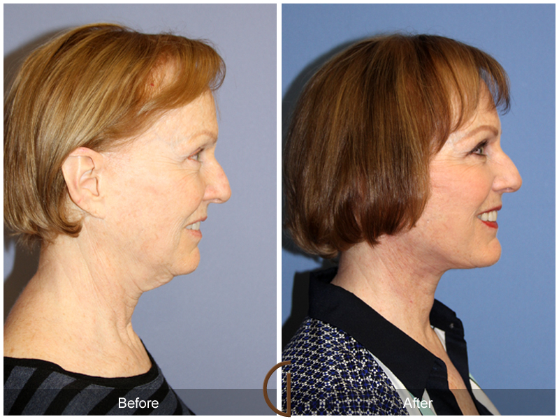 Female Facelift  Before & After Image