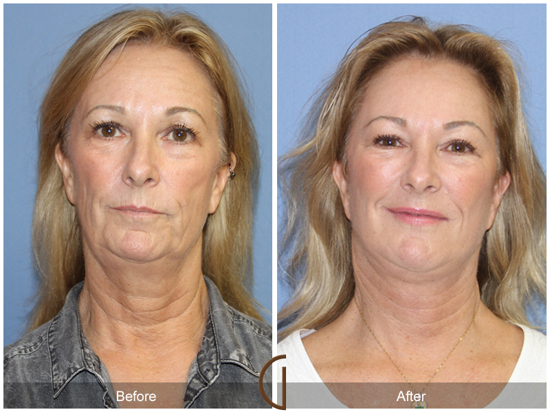 Female Facelift  Before & After Image