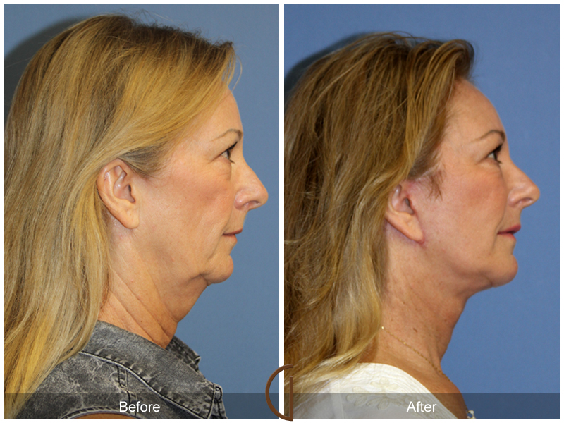 Female Facelift  Before & After Image