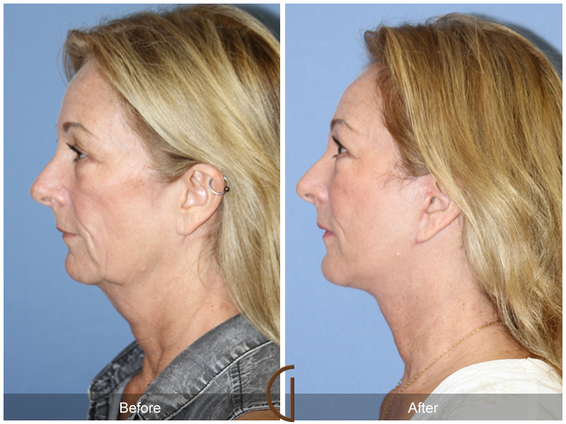 Female Facelift  Before & After Image