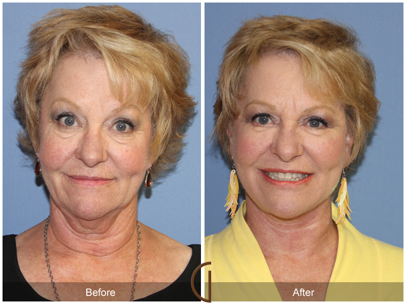 Female Facelift  Before & After Image