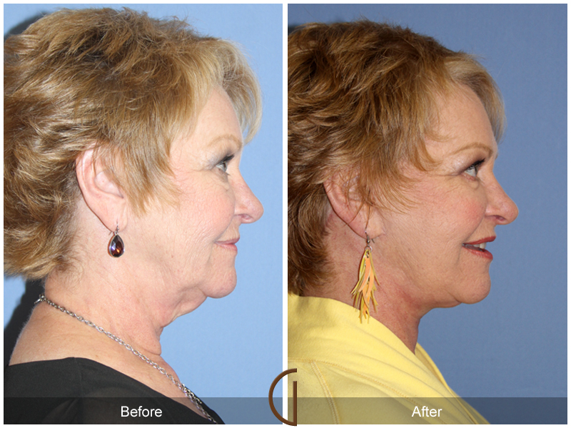 Female Facelift  Before & After Image