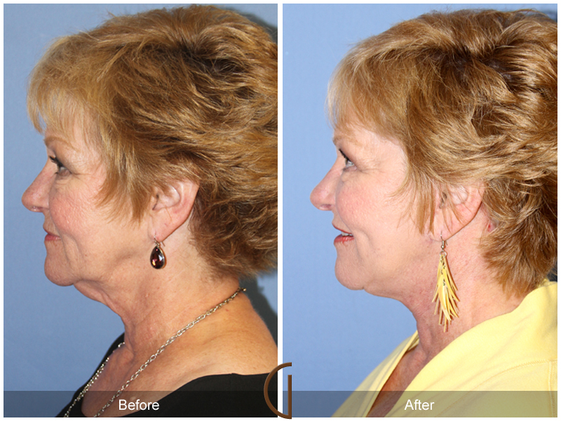 Female Facelift  Before & After Image