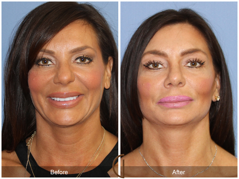 Female Facelift  Before & After Image