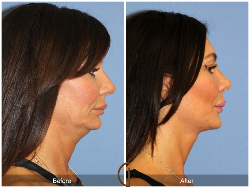 Female Facelift  Before & After Image