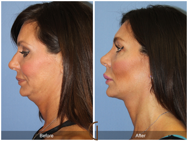 Female Facelift  Before & After Image