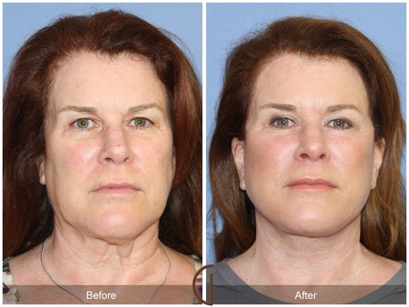 Female Facelift  Before & After Image