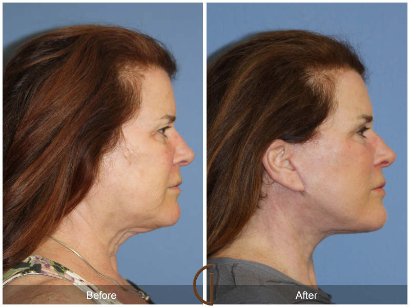 Female Facelift  Before & After Image