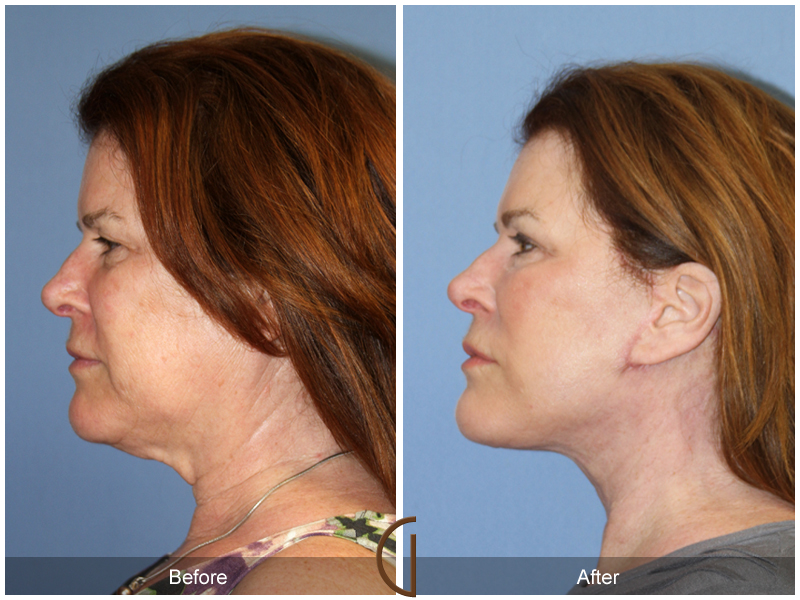 Female Facelift  Before & After Image