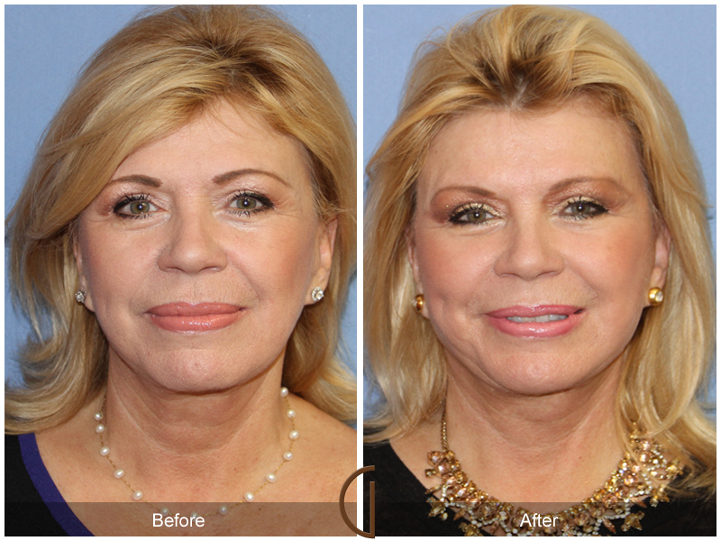 Female Facelift  Before & After Image