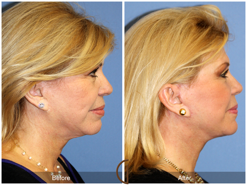 Female Facelift  Before & After Image