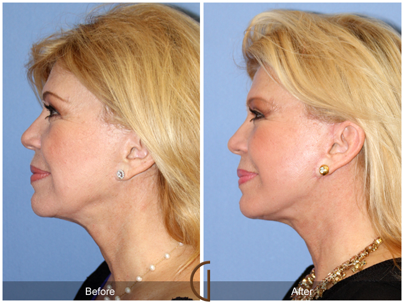 Female Facelift  Before & After Image