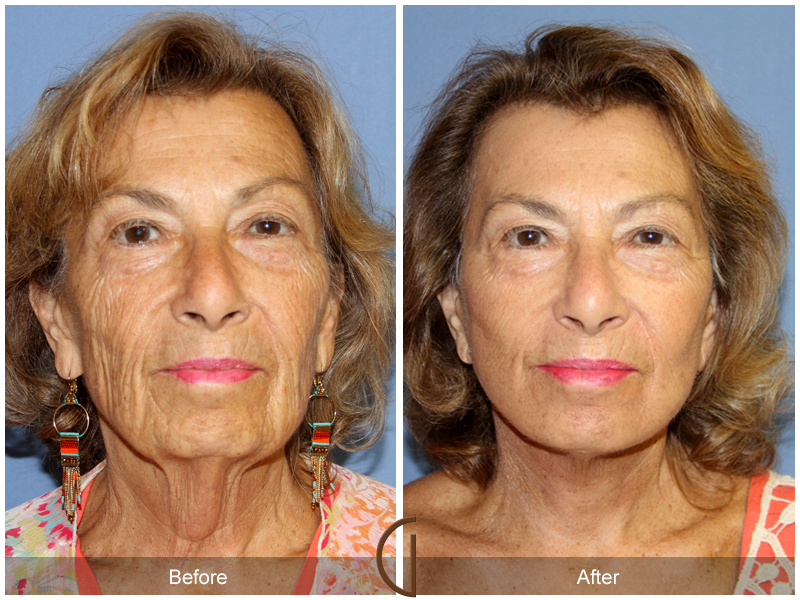 Female Facelift  Before & After Image