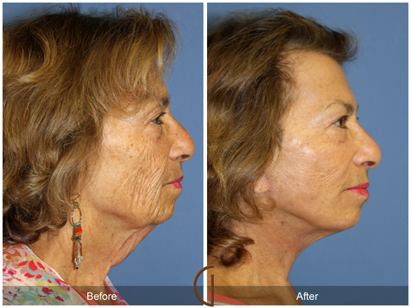 Female Facelift  Before & After Image