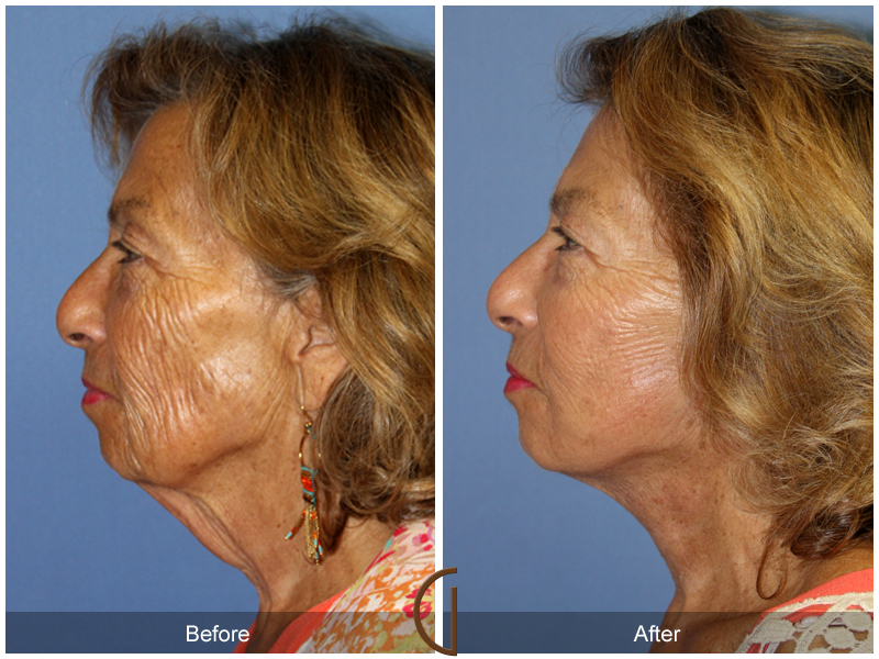 Female Facelift  Before & After Image