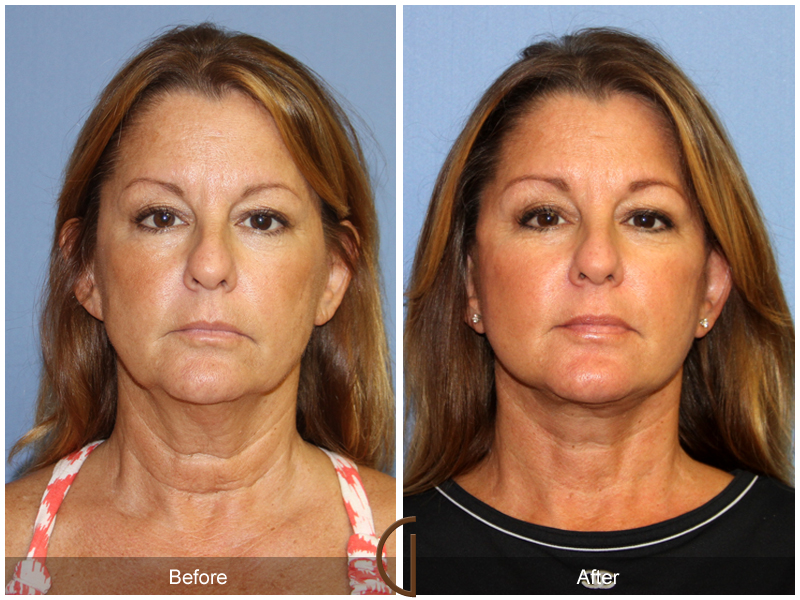 Female Facelift  Before & After Image