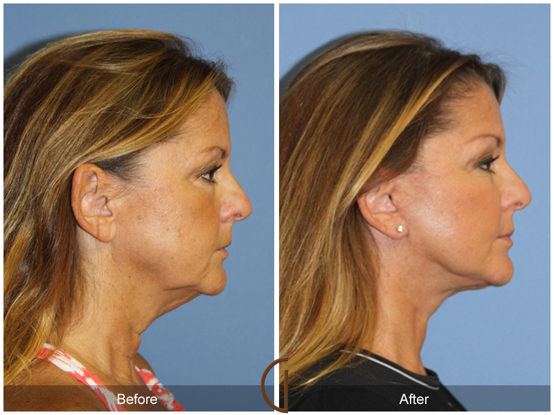 Female Facelift  Before & After Image