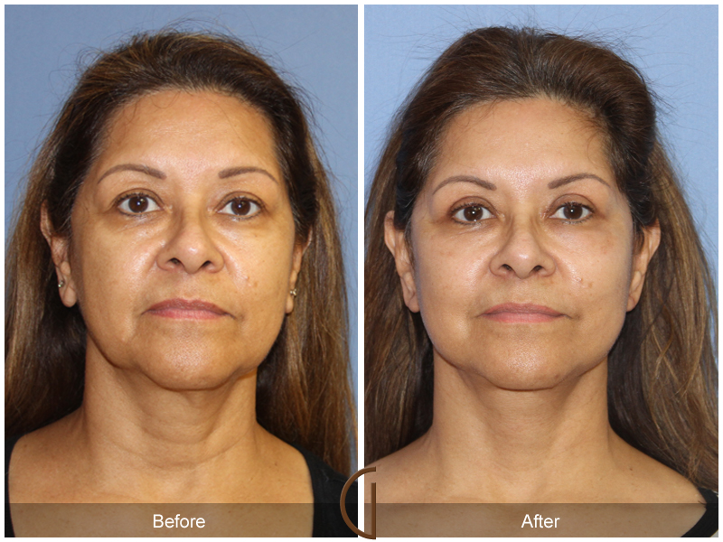 Female Facelift  Before & After Image