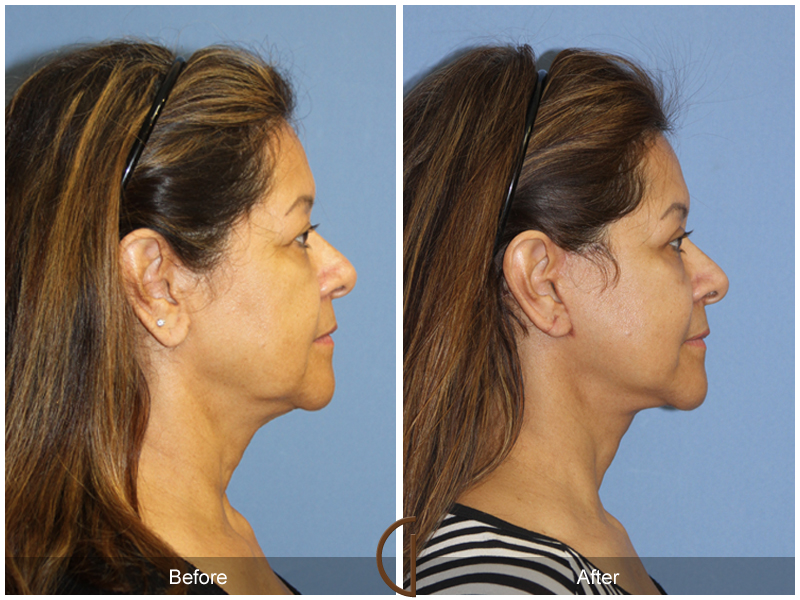 Female Facelift  Before & After Image