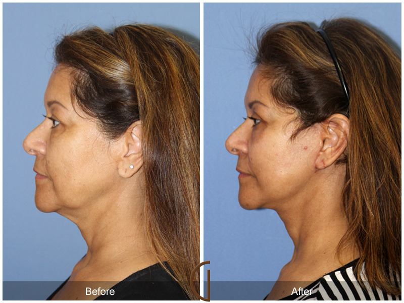 Female Facelift  Before & After Image