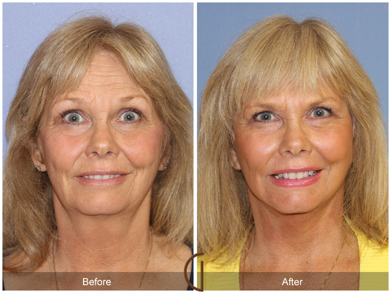 Female Facelift  Before & After Image