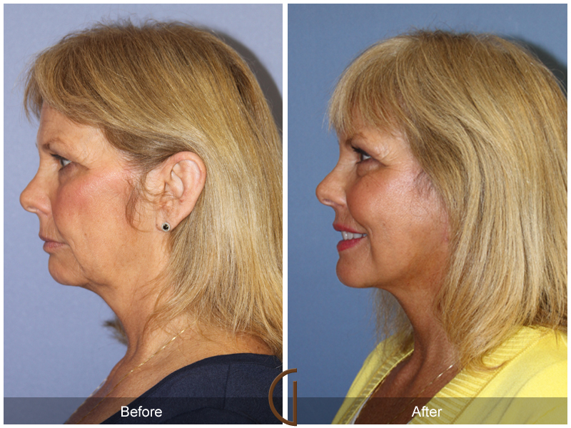 Female Facelift  Before & After Image