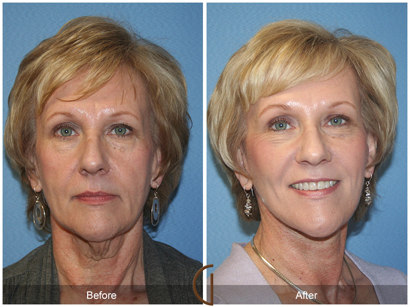 Female Facelift  Before & After Image