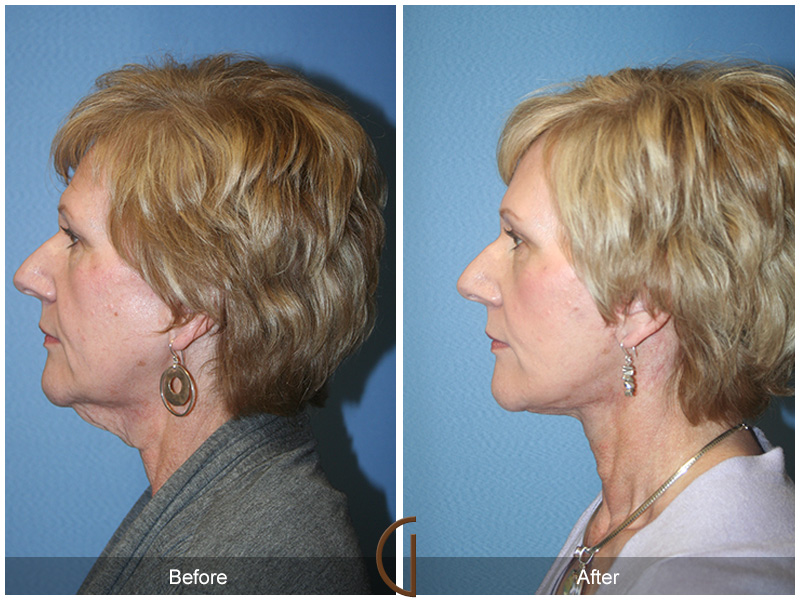 Female Facelift  Before & After Image