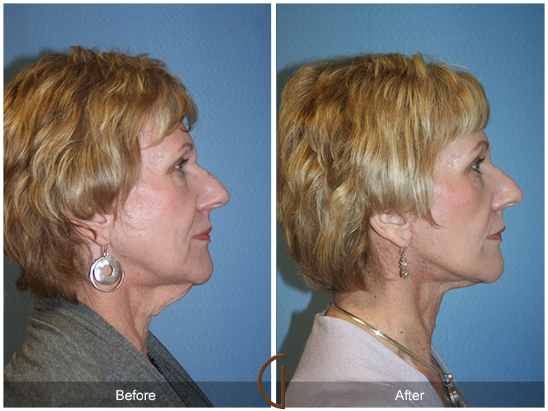 Female Facelift  Before & After Image