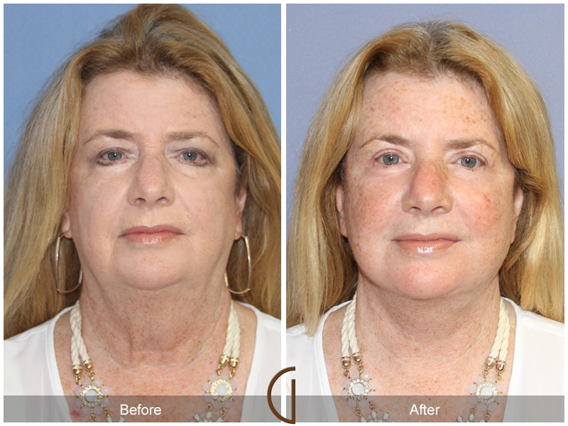 Female Facelift  Before & After Image