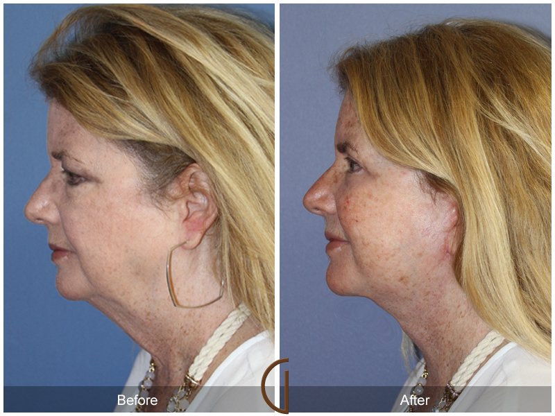 Female Facelift  Before & After Image