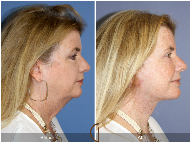 Female Facelift  Before & After Image