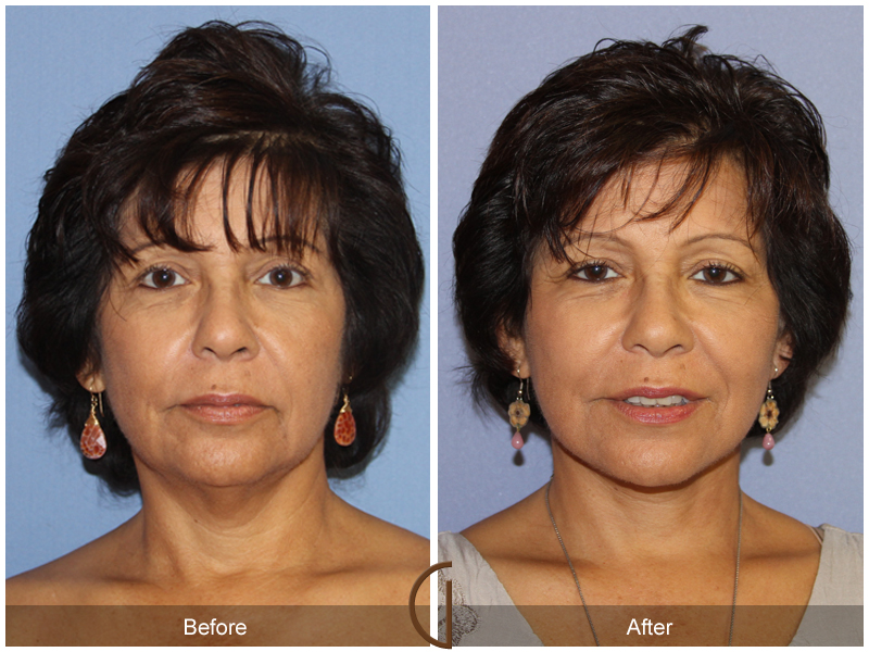 Female Facelift  Before & After Image