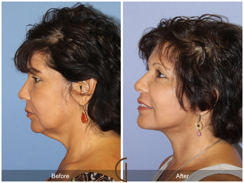 Female Facelift  Before & After Image