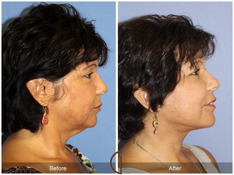 Female Facelift  Before & After Image