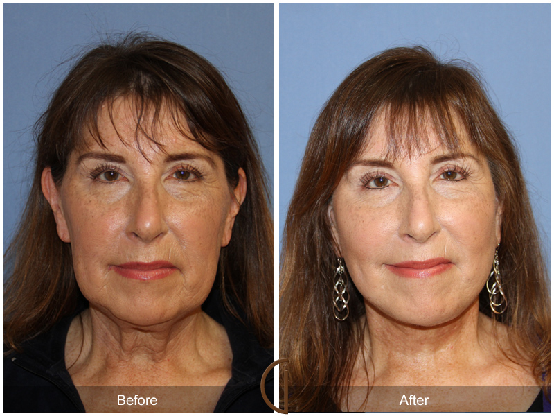 Female Facelift  Before & After Image