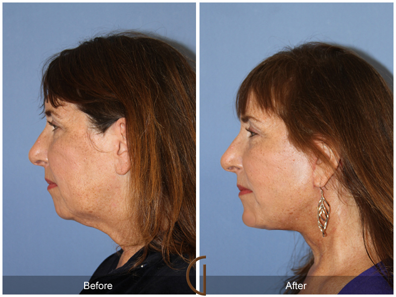 Female Facelift  Before & After Image