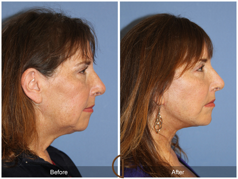 Female Facelift  Before & After Image