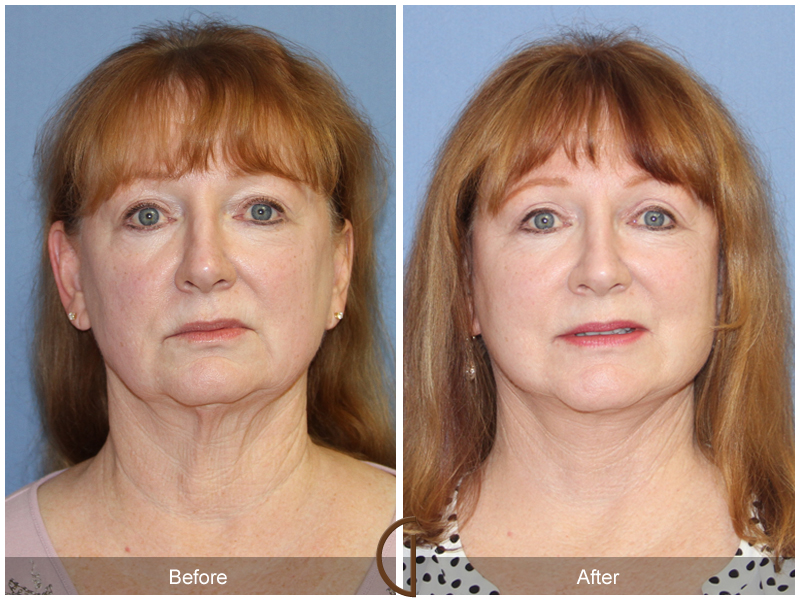 Female Facelift  Before & After Image