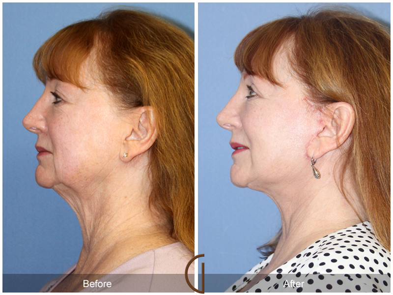 Female Facelift  Before & After Image