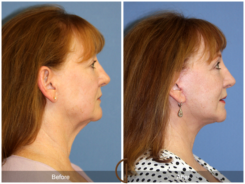 Female Facelift  Before & After Image