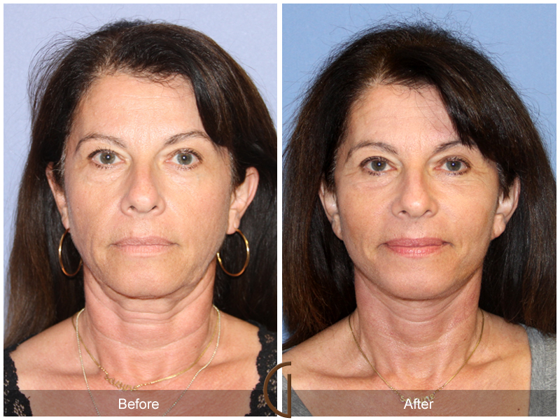 Female Facelift  Before & After Image