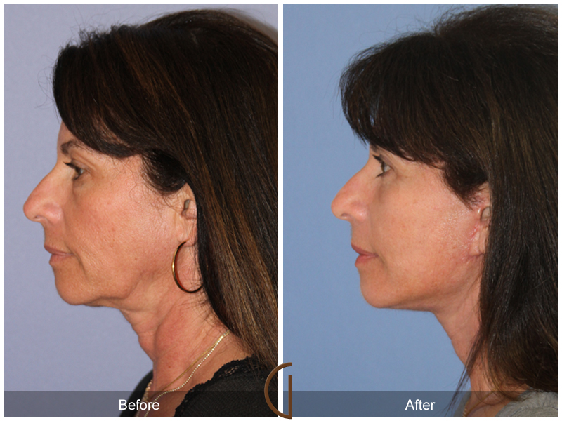 Female Facelift  Before & After Image