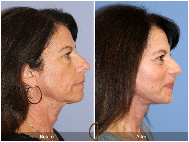 Female Facelift  Before & After Image