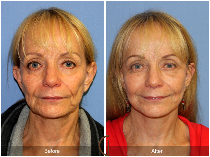 Female Facelift  Before & After Image